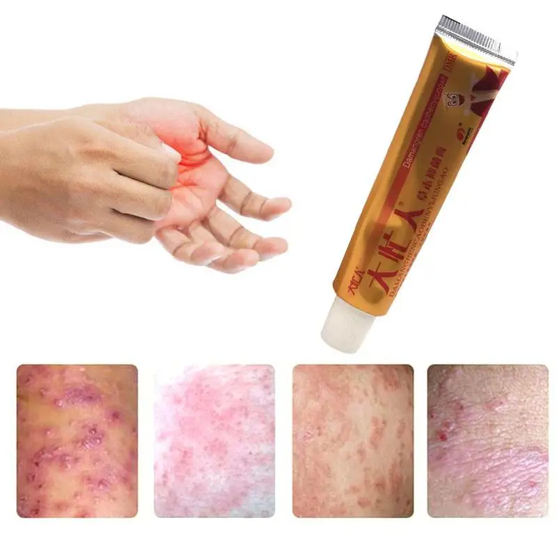 Китайский травяной Антибактериальный крем, псориаз, дерматит Eczema Pruritus Oinments, крем для удаления проблем с зудящей кожей