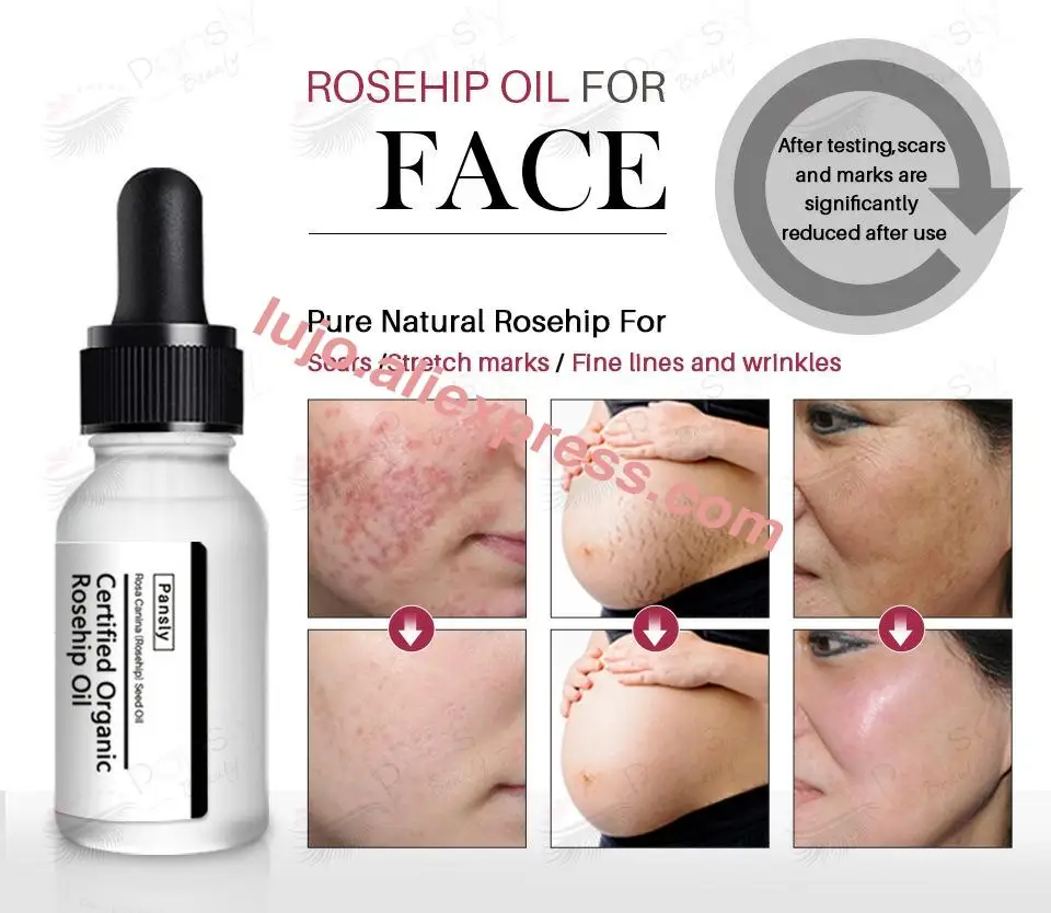 Средство для удаления растяжек эфирное масло средство морщин шрамов крем тела и