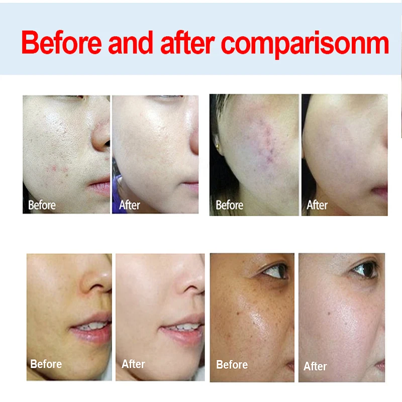 Многофункциональное вакуумное устройство для очистки лица водородный кислород