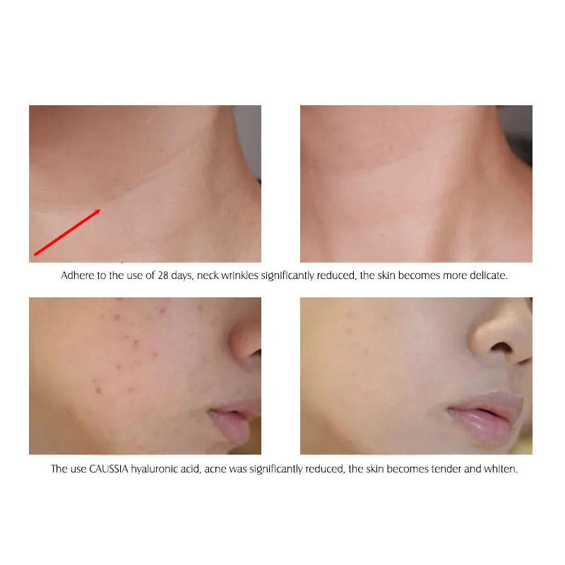 10 шт. отбеливающая сыворотка с гиалуроновой кислотой|Сыворотка| |