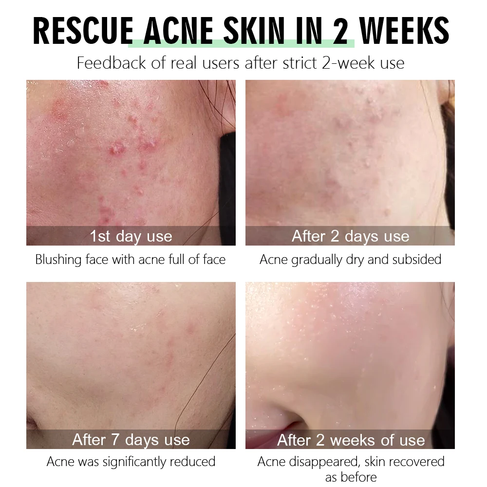 Крем для лица с экстрактом чайного дерева отбеливающий и увлажняющий|Дневные