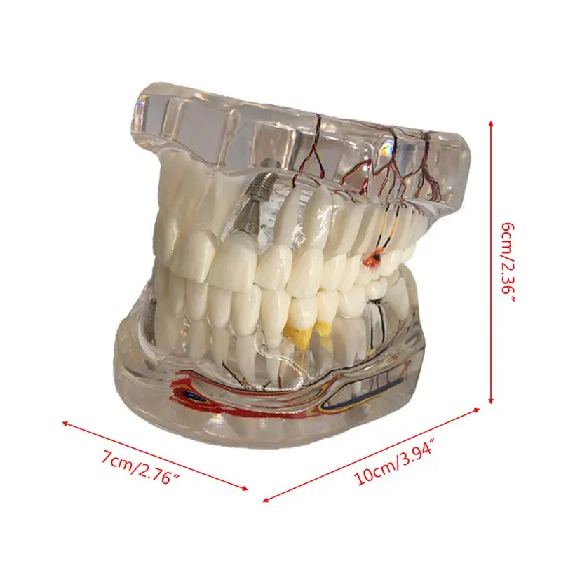 

Dental Disease Implant Teeth Model with Restoration Bridge Tooth Dentist for Medical Science Disease Teaching Study