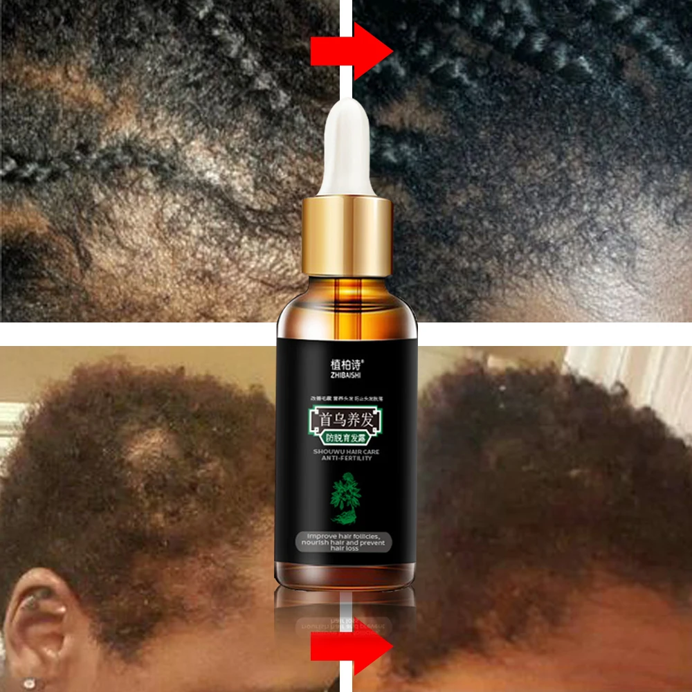 3 шт. сыворотка для роста волос масло эссенция лечение выпадения тоник продукты