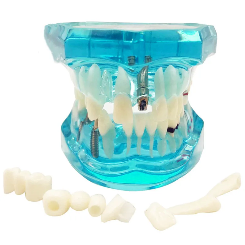 Модель зубная прозрачная для восстановления зубов модель внедрения заболеваний