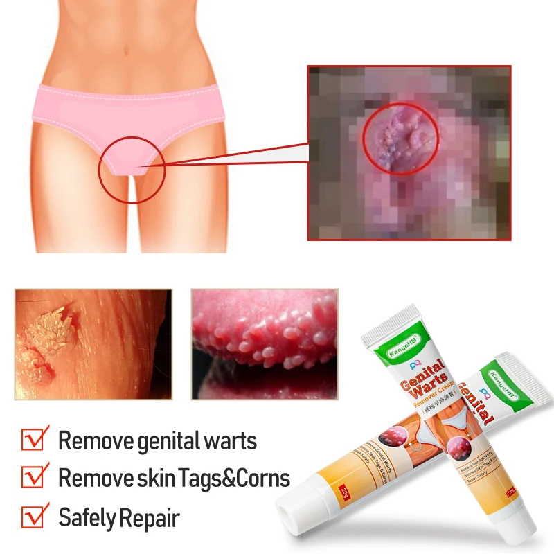 2pcs Wart Remover Ointment Genital Herpes Vulva Condyloma Acuminatum Skin Tag Antibacterial Treatment Cream A658 | Красота и здоровье