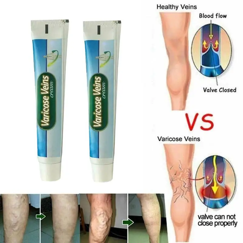 

Varicose Veins Treatment Cream Vasculitis Phlebitis Angiitis Inflammation Blood Vessel Rotten Legs Spider Repair Ointment Useful