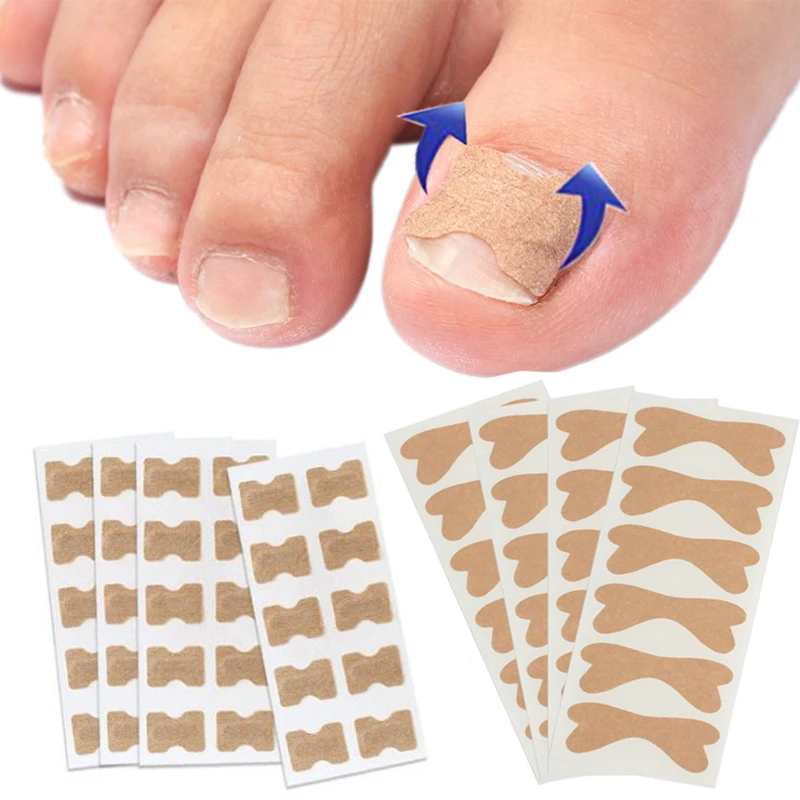 

Pedicure Ingrown Nail Tools Toenail Stickers for Nails Corrector Paronychia Treatment Fixer Recover Bunion Pedicura Feet Care