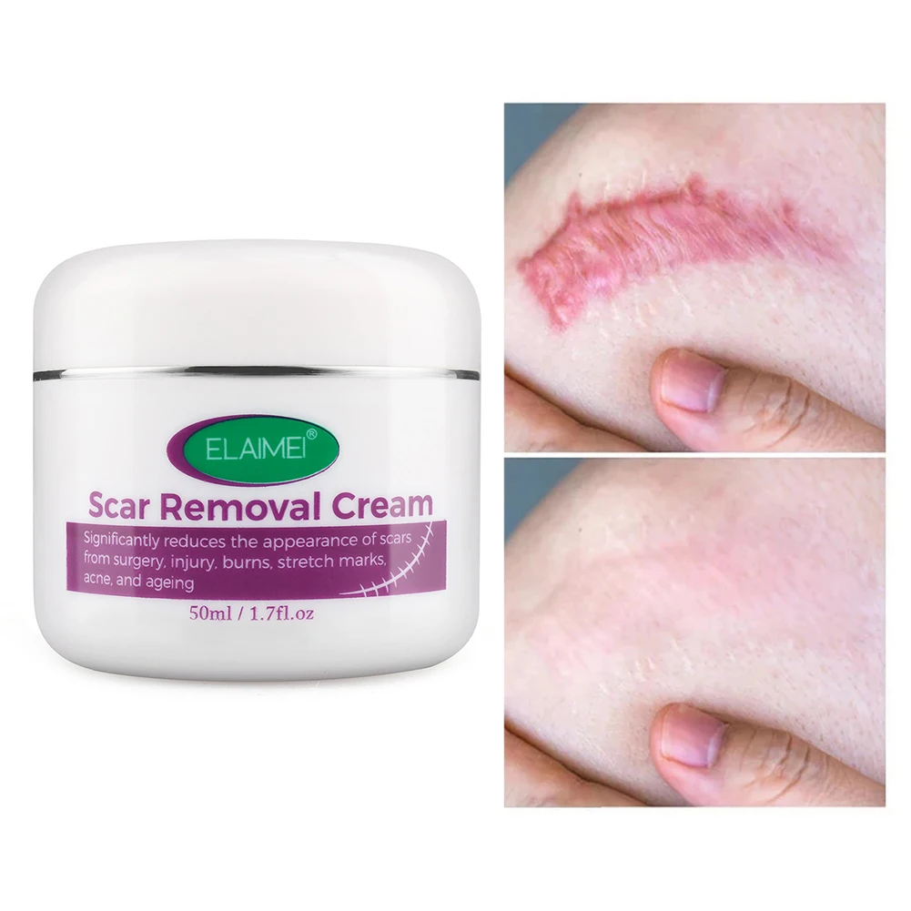 Scar Removal Cream for Acne Marks Burns Stretch Mark Surgical Scars Promote New Skin Growth Treatment Care | Красота и здоровье