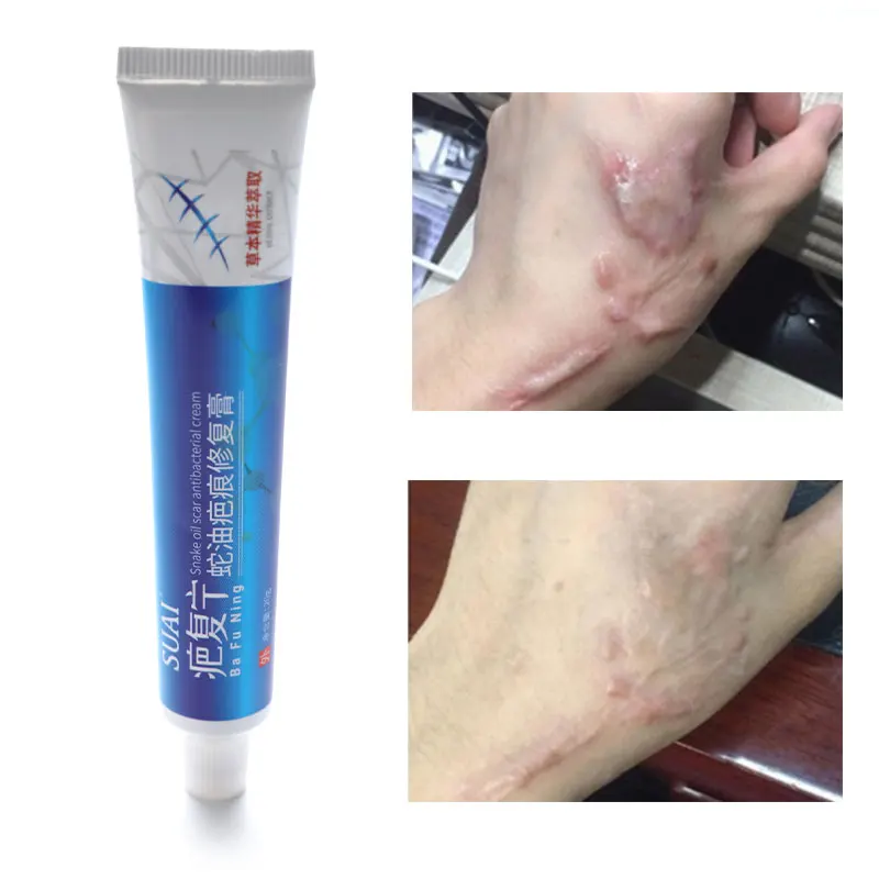 

Acne Scar Removal Cream Pimples Stretch Marks Face Gel Remove Acne Smoothing Whitening Moisturizing Body Skin Care