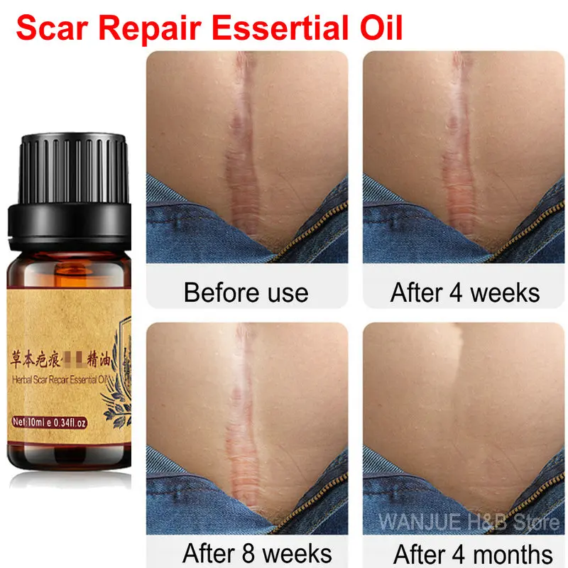 

Масло для удаления шрамов, акне, пятен, прыщей, растяжек, гель для лица, удаление акне, восстановление, разглаживание, отбеливание, увлажнени...