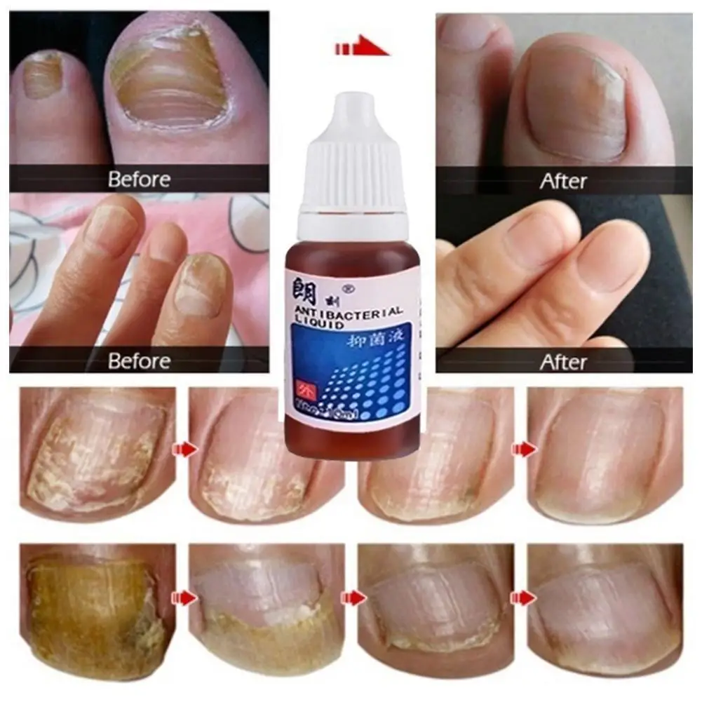 

Nail Fungal Treatment Feet Care Essence Nail Foot Whitening Nail Gel Fungus Anti Infection Toe Paronychia Onychomycosis Rem K8E9