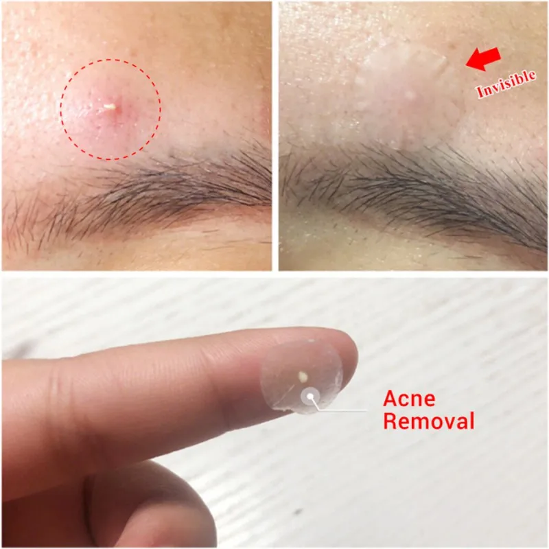 Acne Patch Skin Remover Pimple Master Patch Treatment Removal Black Head remover Acne Remover
