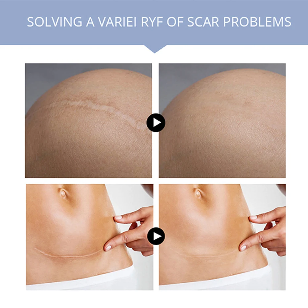 20g Body Scrubs Scar Removal Cream Skin Trauma Surgery Repair Acne Essence Gel Care Products |