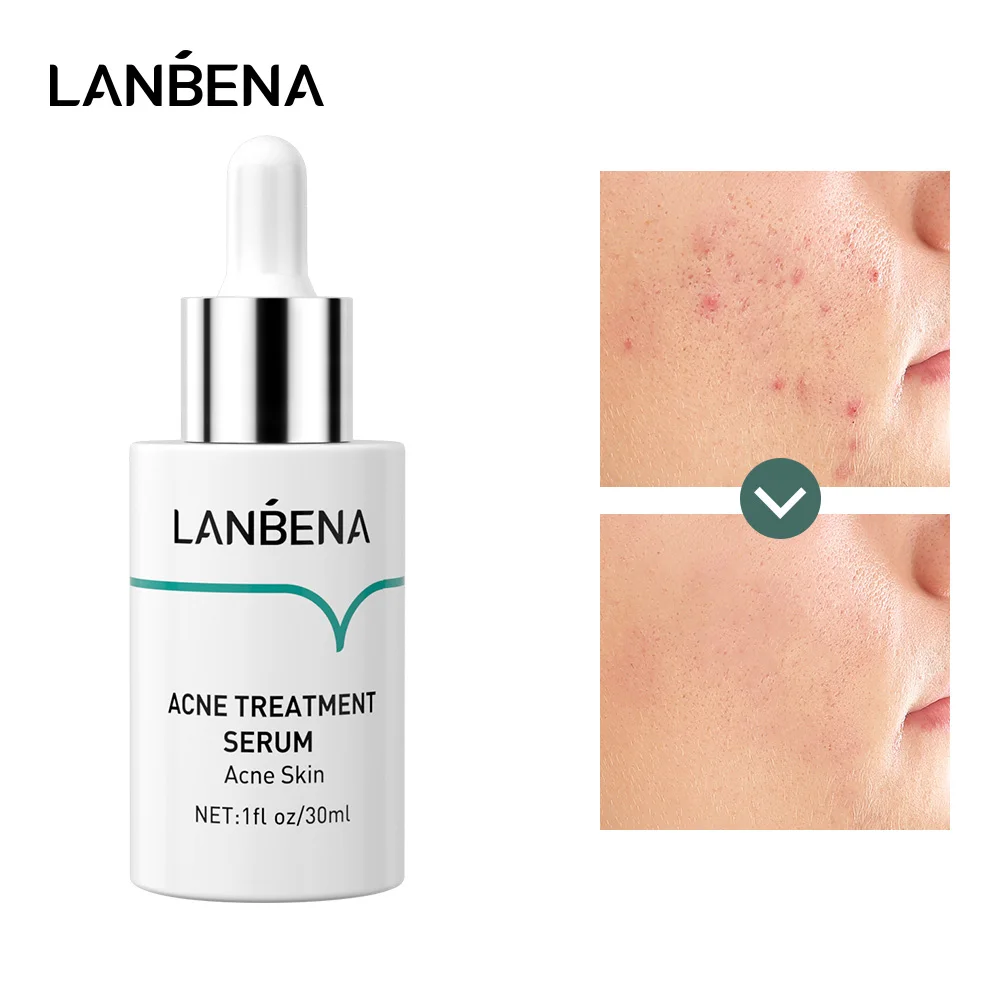 

LANBENA 30ml Oligopeptide Anti Acne Solution Plant Extracts Acne Treatment Serum Reduce Mark Shrink Pores Deep Repair Skin Care