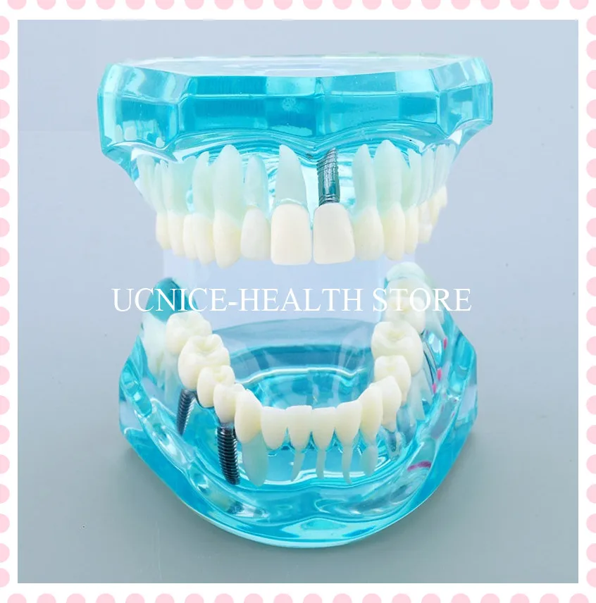 Модель имплантата и реставрации с нервом/зубным имплантатом модель M2001 на зажиме