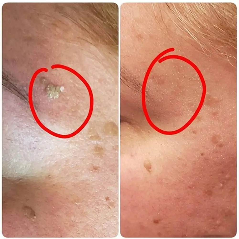 

10/20/30ml Wart Liquid Skin Tag Remover Essence Papillomas Mole Treatment Serum Skin Corn Care Against Remover Liquid Tool I1C4