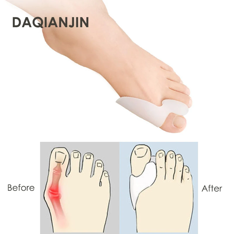 1 пара силиконовые разделители большого пальца ноги для коррекции вальгусной