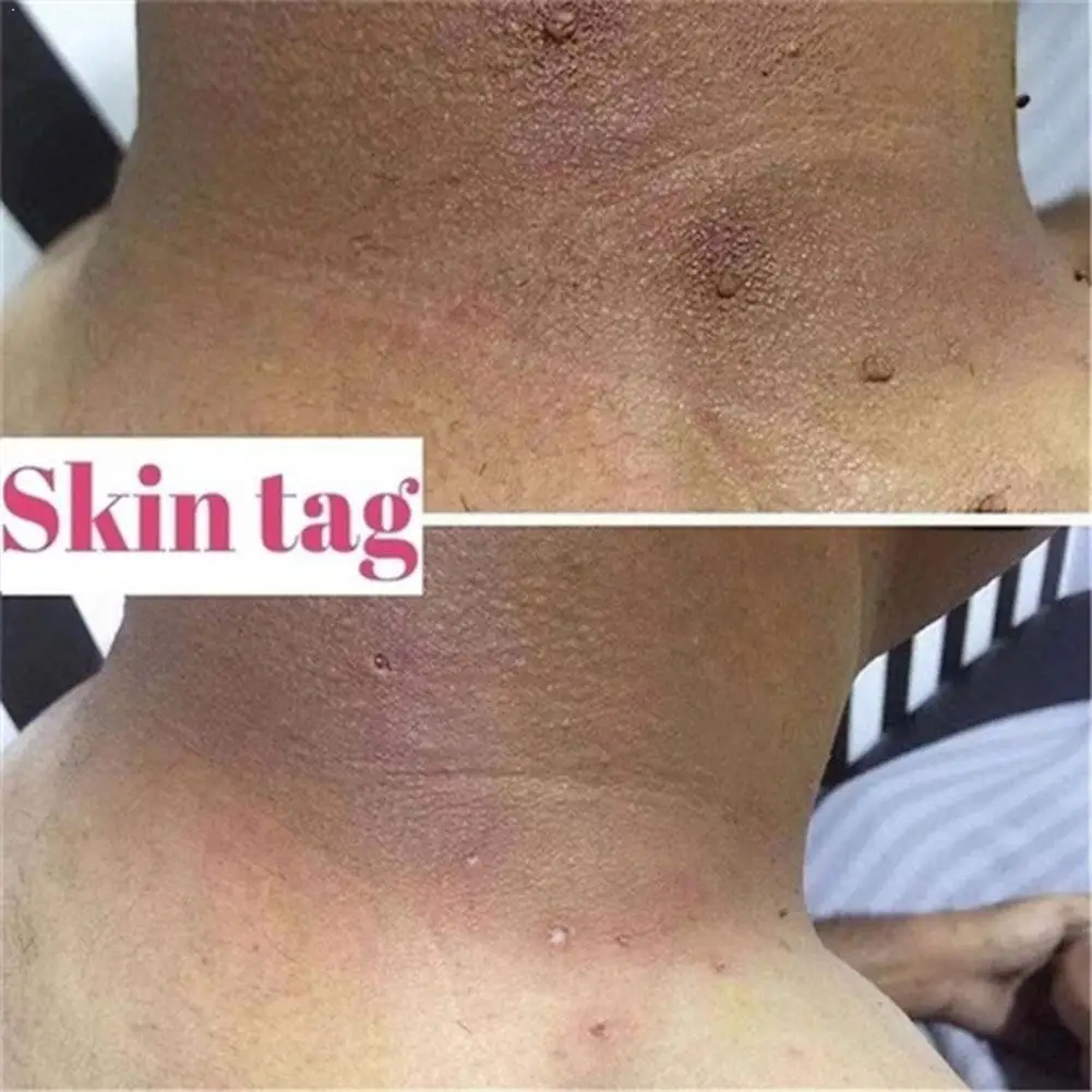 

Ultra Strength Natural Health Mole Nevus Wart Skin Foot Warts Tag Removal Skin Tag Treatment Corn U1O2