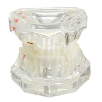 implant dental disease teeth model with restoration bridge tooth dentist for medical science dental disease teaching study tool