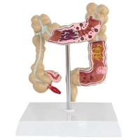 aay colorectal lesion model human colon large intestine pathological diseases model medical mrganizer anatomy