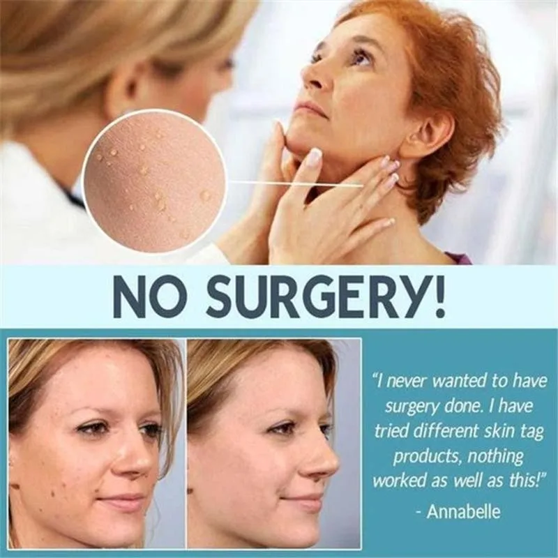 

10/20/30ml Skin Tag Remover Liquid Wart Removal Freckle Wart Dark Spot Remover Wart Body Tag Freckle Skin Care Liquid