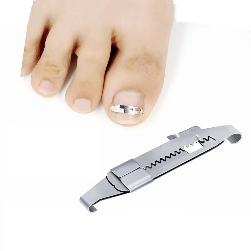 Инструменты для педикюра вросших ногтей на ногах профессиональное лечение