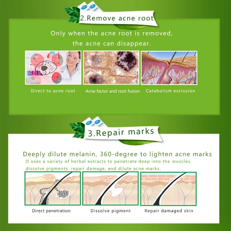 2019HOT Acne Treatment Face Cream Anti Acne Scar Removal Pimple Blackhead Moisturizing Whiten Oil-control Shrink Pores Skin Care
