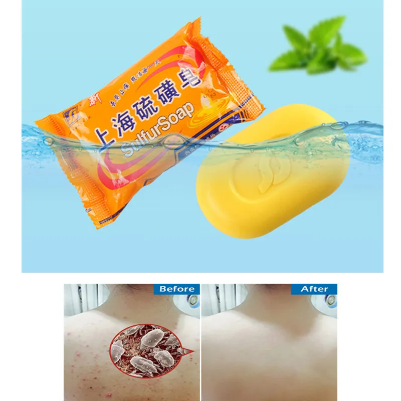 Шанхай серное мыло для контроля жирности лечение акне средство удаления черных