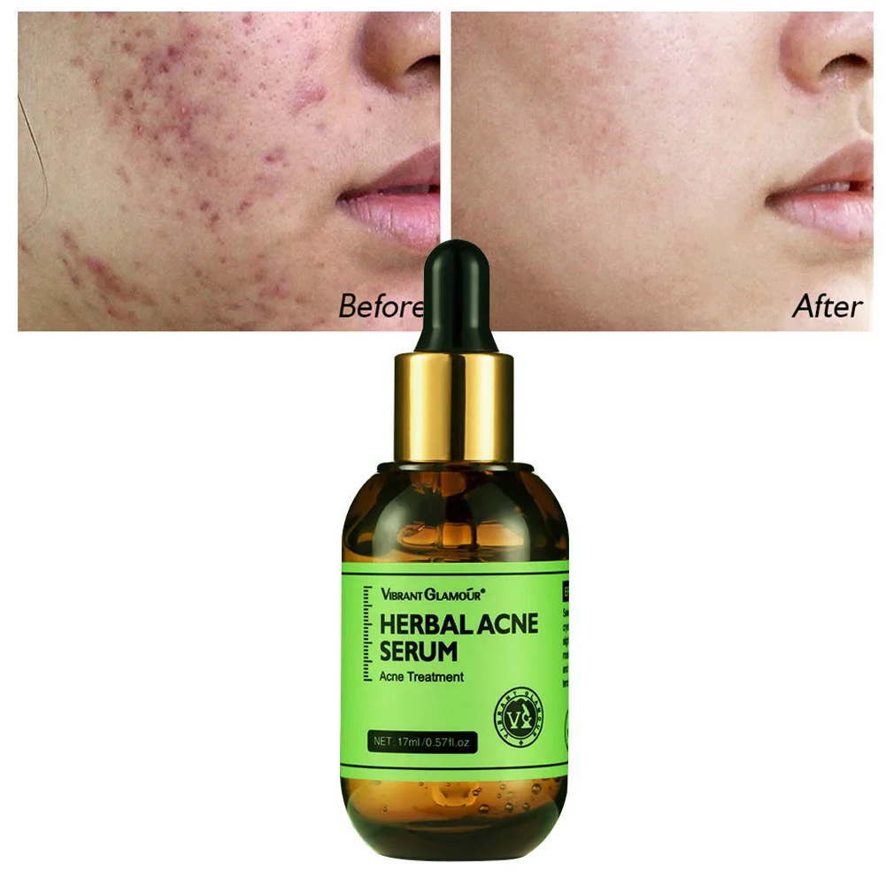 

Acne Treatment Herbal Acne Treatment Serum Oil Control Brighten Nourish Whitening Shrink Pores Remove Scars Marks Skin Care 17ml