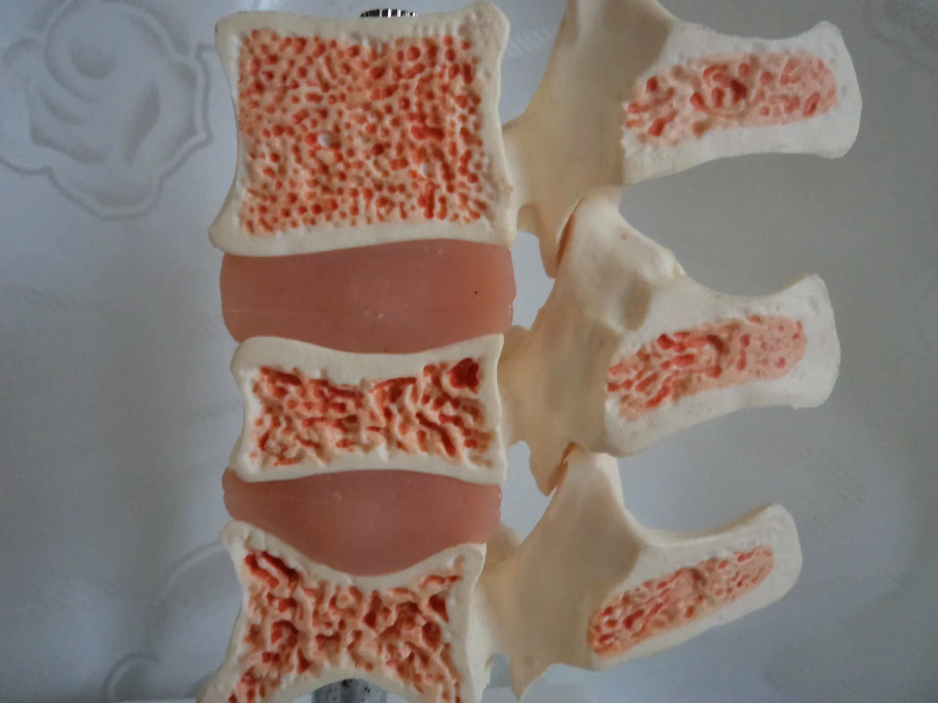 

Модель остеопороза, патологическая модель позвоночника, модель позвоночника человека, анатомический скелет, заболевания позвоночника, Мед...
