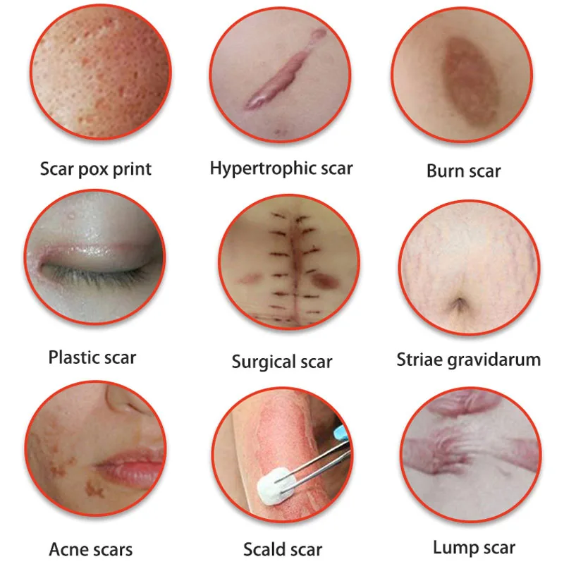 Крем для удаления шрамов от акне 30 г | Красота и здоровье