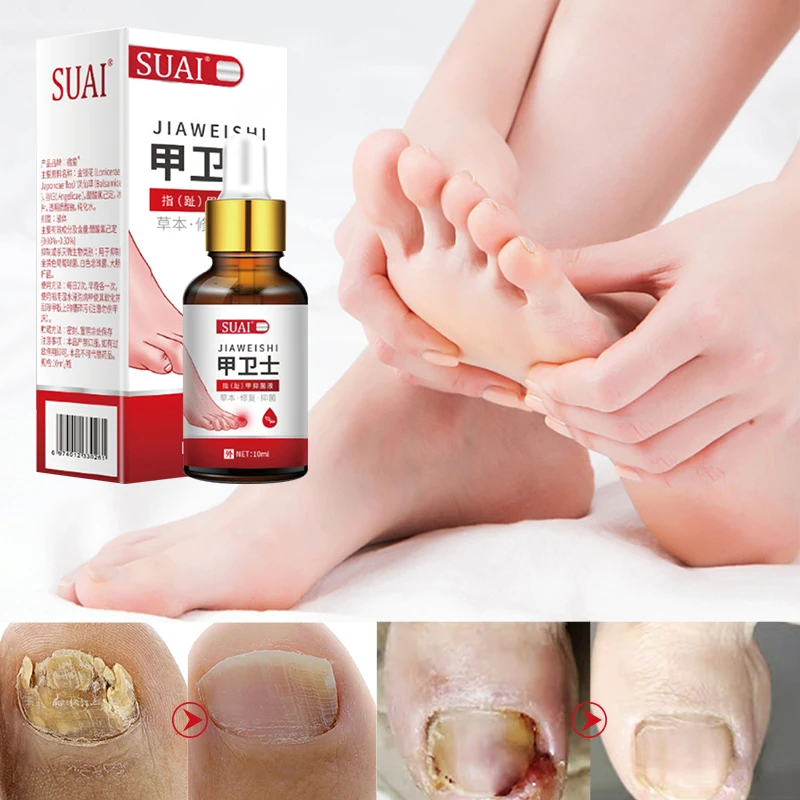 

Nail Fungal Treatment Feet Care Essence Nail Foot Whitening Toe Nail Fungus Removal Gel Anti Infection Paronychia Onychomycosis