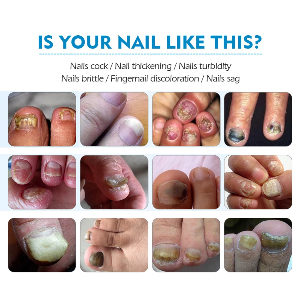 20g Nail Fungus Treatment Cream Onychomycosis Paronychia Anti Fungal Infection Kills Bacteria And | Красота и здоровье
