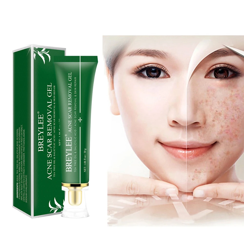 

30g Acne Scar Gel Facial Cream Whitening Moisturizing Acne Blackhead Shrink Pores Soothing Sensitive Skin Care Facial Cream