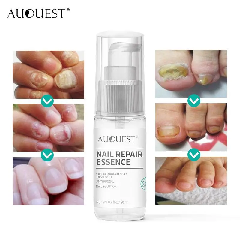 

AuQuest 20ML Nail Fungus Treatment Feet Care Essence Crack Repair Nail Toenail Bed Treatment Anti Paronychia Onychomycosi