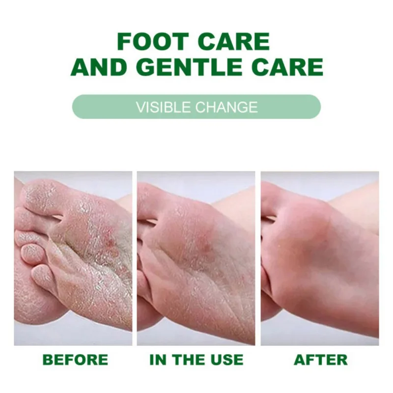 

Foot Treatment Cream Whitening Anti-cracking Moisturizing Protection Cream Relive Pain Foot Cream Exfoliating Scrub