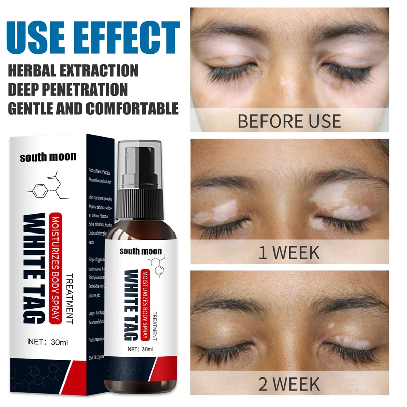 

White Spot Remover Spray Herbal Antibacterial Vitiligo Treatment Body Spray Leukoplakia Disease Pigment Melanin Repair Face Care