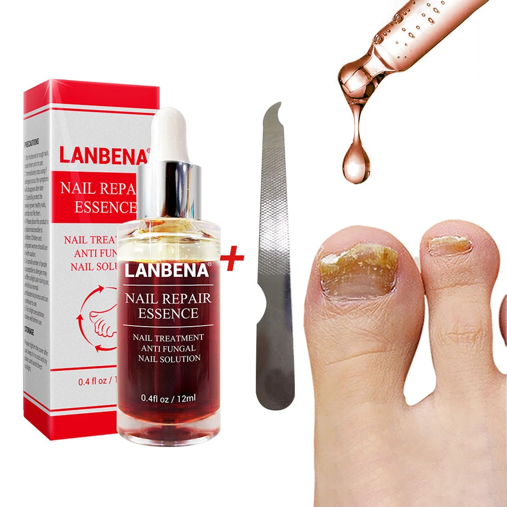

Onychomycosis Nail Fungal Treatment Feet Care Essence Nail Foot Whitening Toe Nail Fungus Removal Gel Anti Infection Paronychia