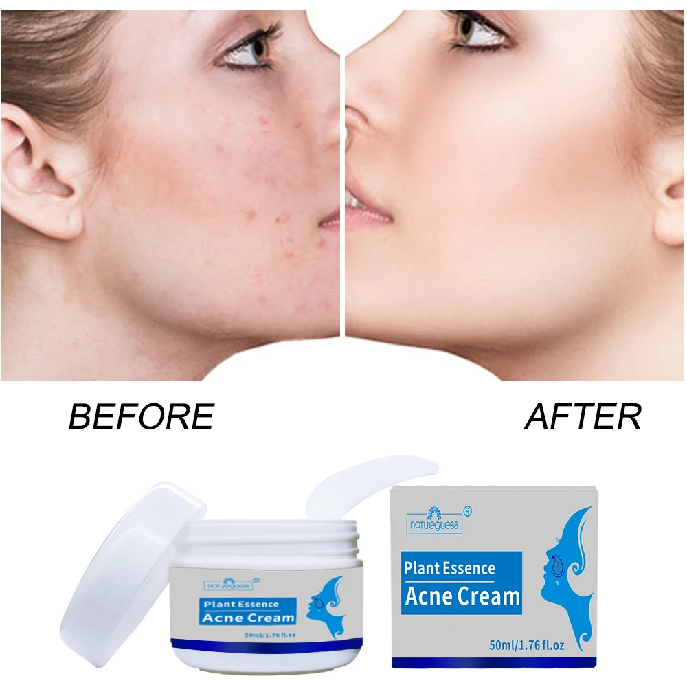 Крем для удаления акне 50 г контроль жирности сужение пор удаление шрамов угрей