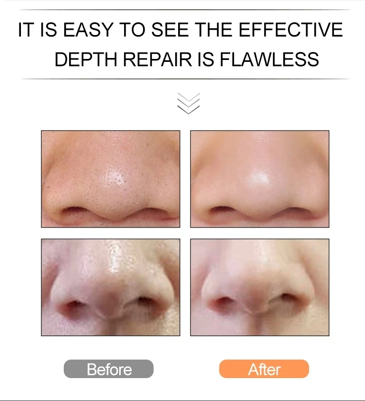Acne Facial Blackhead Remover Pore Cleaner Vacuum electric facial massager machine | Красота и здоровье