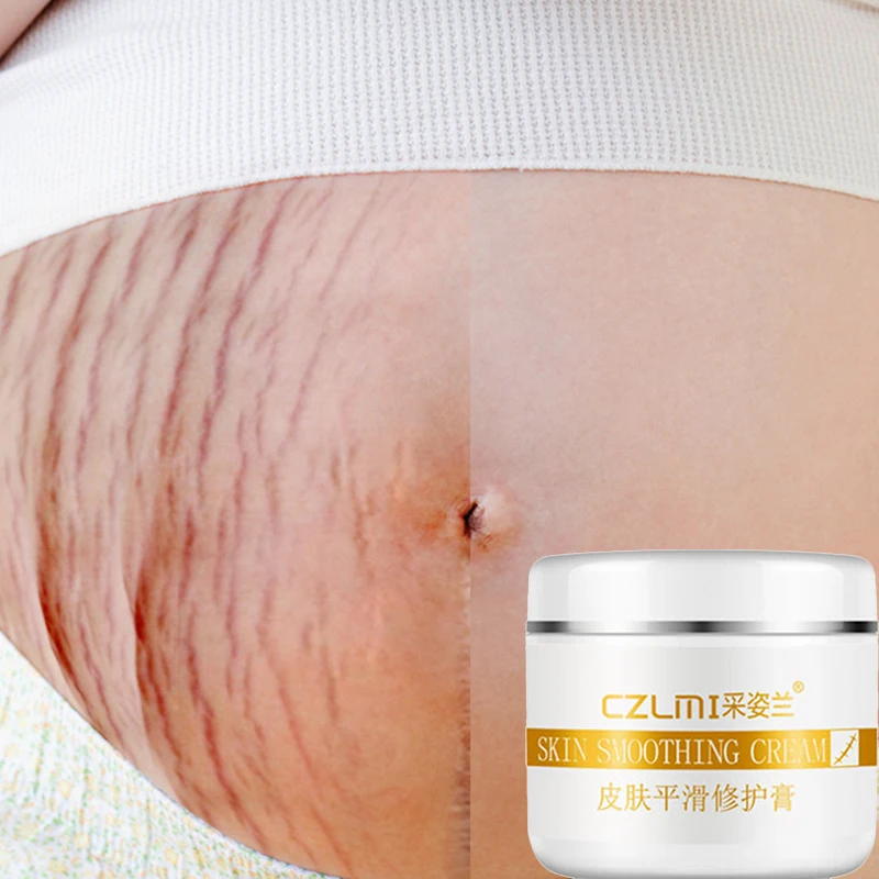 Removal Scar Cream Face Pimples Scar Stretch Marks Removal Acne Treatment Whitening Moisturizing Cream Skin Care TSLM1