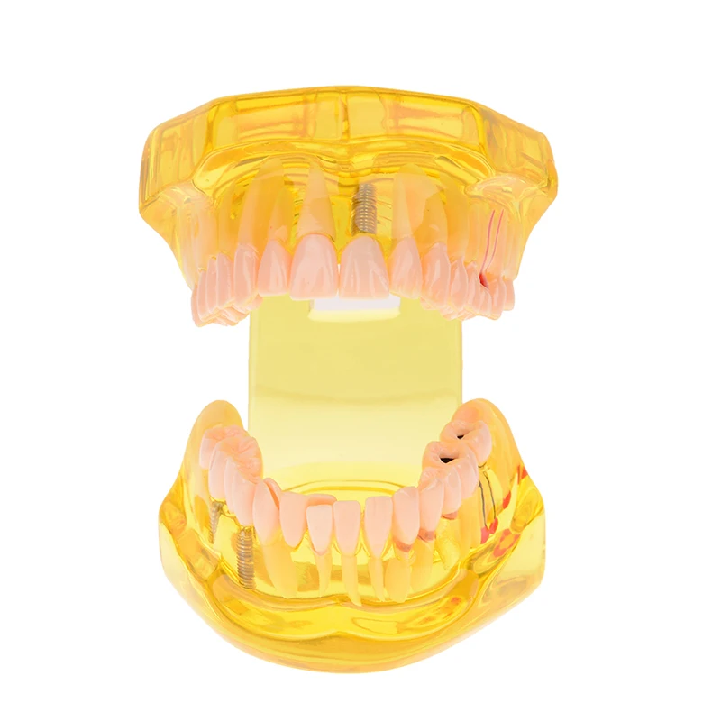 

New Dental Implant Disease Teeth Model With Restoration Bridge Tooth Dentist For Medical Science Dental Disease Teaching Study