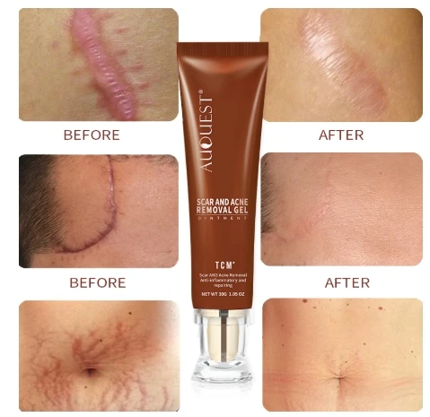 Мазь TCM для лечения акне и удаления шрамов гелевая мазь следы от черных точек