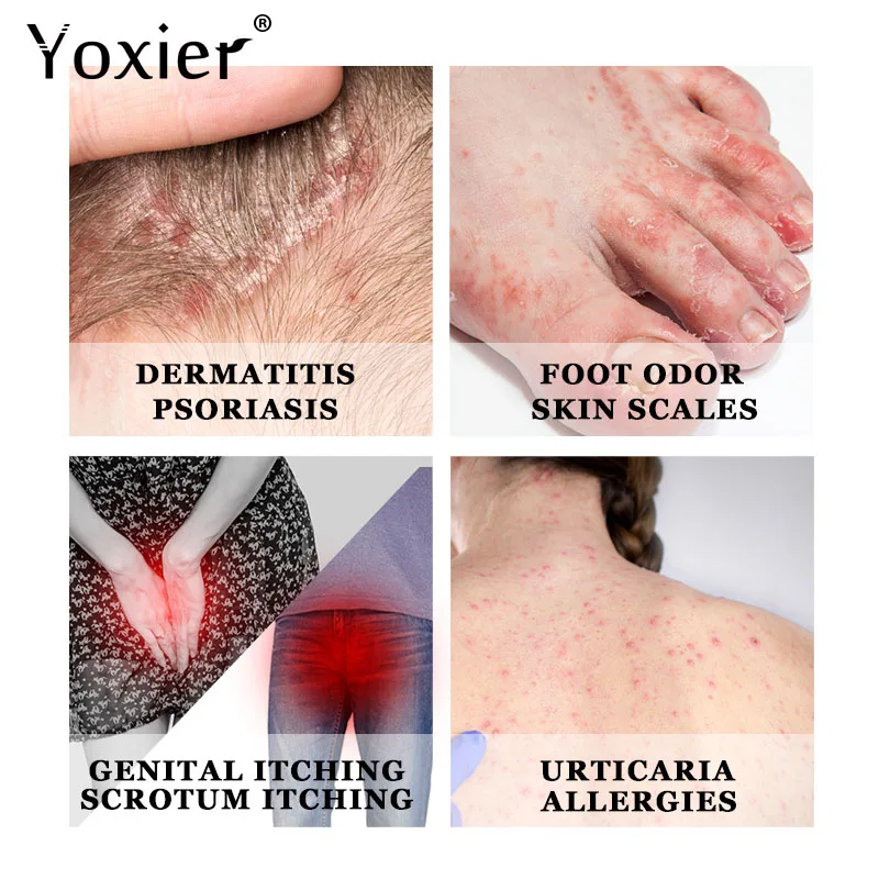 Антибактериальный крем Yoxier эффективное средство против зуда псориаз дерматит