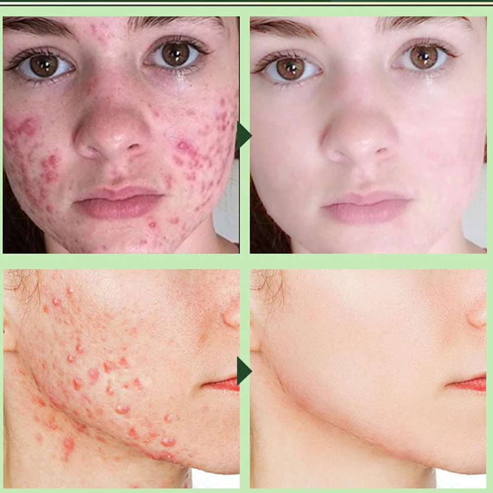 

Oil Control Moisturizing Cleansing Mask Acne Treatment Cream Blackheads Acne Clearing Acne Soothing Cream Acne Cream