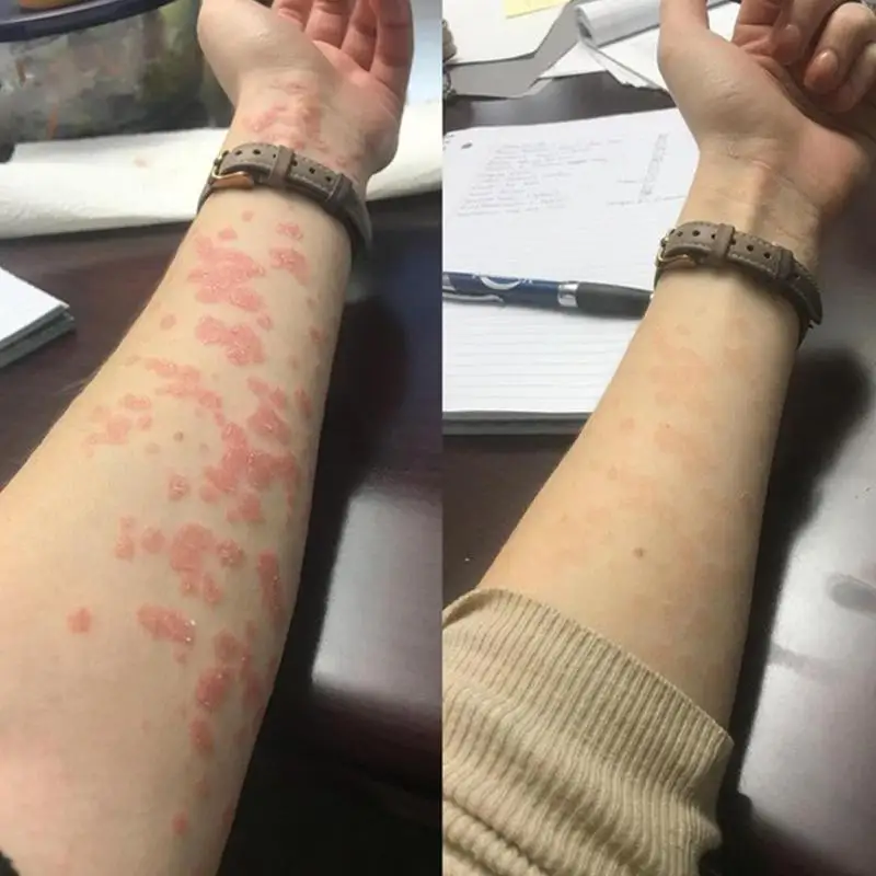 

Zhiyangning Children Adult Mosquito Bites Stubborn Swelling Redness Skin and Itching T1E0