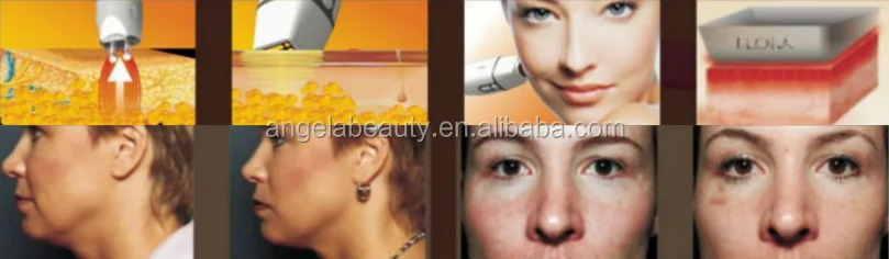 

A-V500 Hot selling professional RF skin tightening face lifting wrinkle removal radiofrequenc beauty equipment