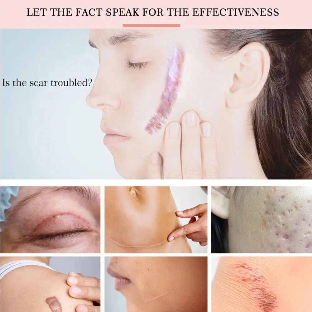 Восстанавливающий Крем Для рубцов с лавандой удаляет ожоги улучшает регенерацию