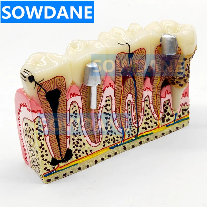 Зубные протезы модель обычной патологии обучающая зубной Стоматолог для изучения медицины