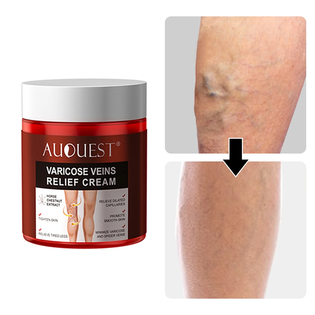 

Beauty Health Varicose Veins Cream Swollen Legs Pain Relief Spider Veins Treatment Legs Pain Relief Ointment Massage Soothing